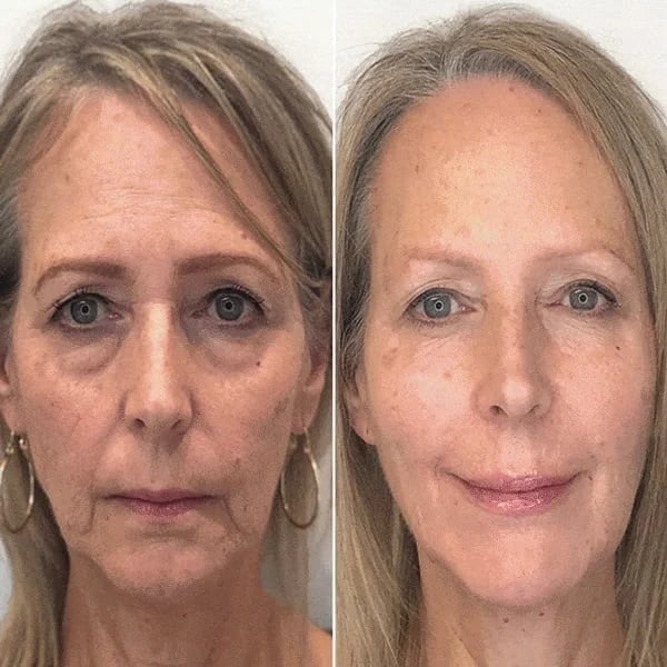 Last Day Promotion 70% OFF - đ„Botox Face Serum