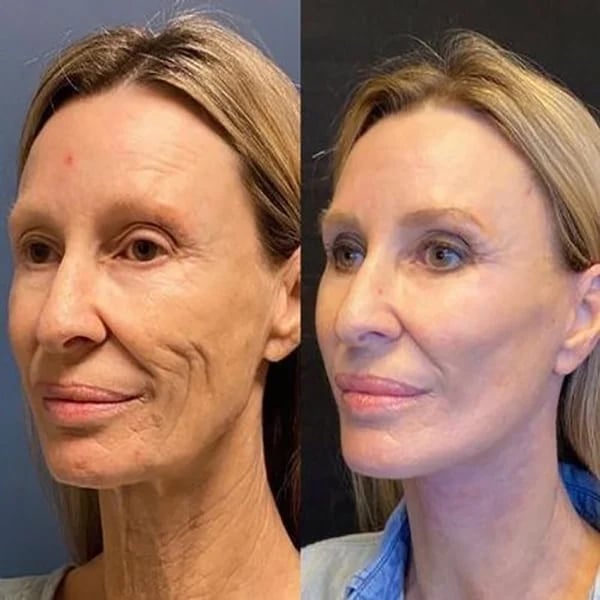 Last Day Promotion 70% OFF - đ„Botox Face Serum