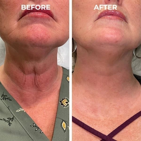 Last Day Promotion 70% OFF - đ„Botox Face Serum