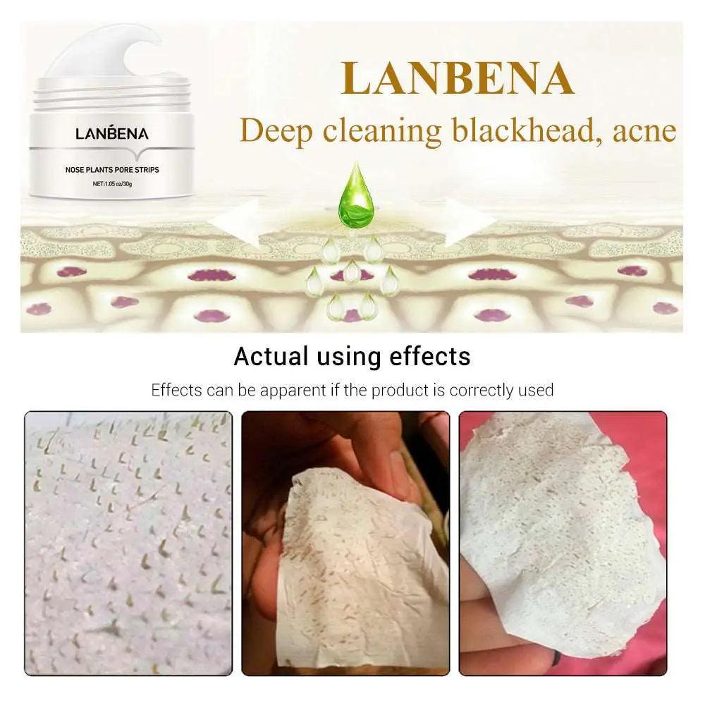 Blackhead Nasal Membrane Removal: Suction, Tearing