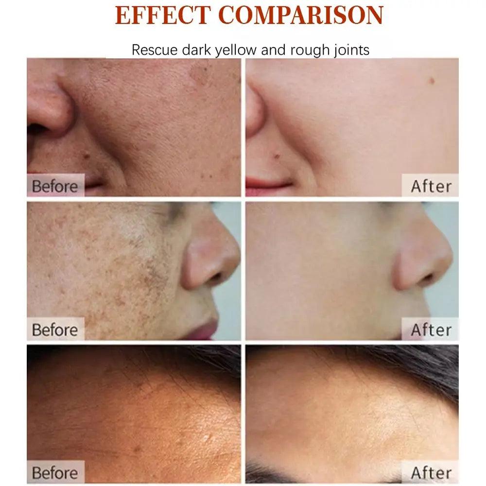 Korean Vegan Neck Remover: Vitamin C, Pimple Dark Spot