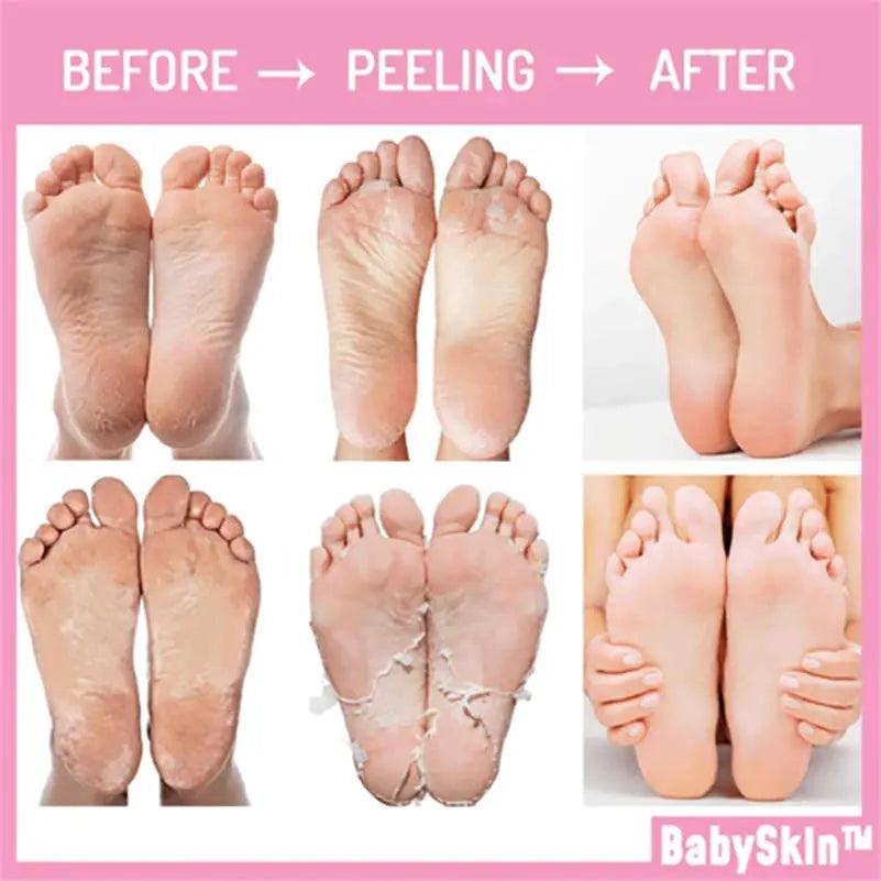 BabySkin Original Peeling Foot Mask