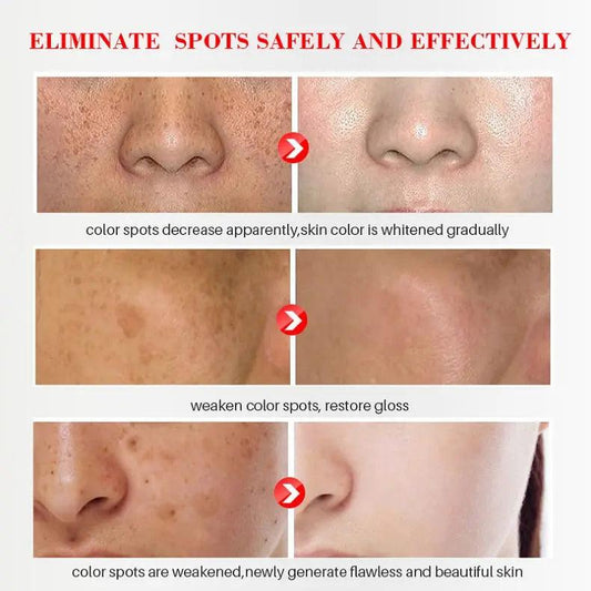 Whitening & Freckle Cream: Spot Reduction & Moisturizing