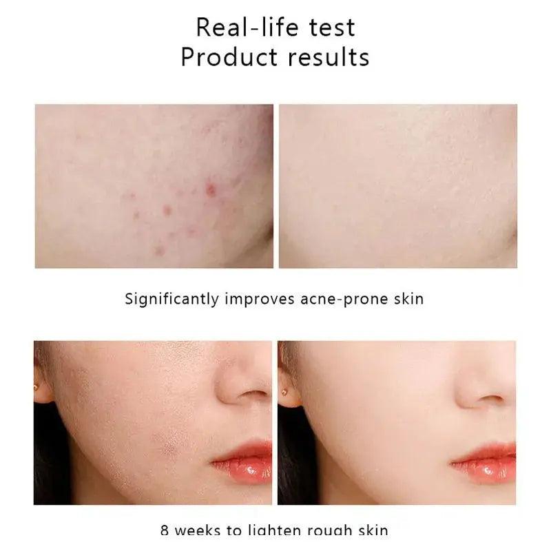 Original Niacinamide 10% + Zinc 1% B5 Essence Fruit Acid 30% Salicylic Caffeine Vitamin Moisturizes Tightens Soften Skin Care