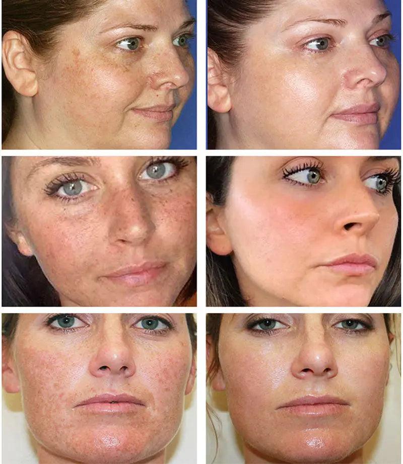 Whitening & Freckle Cream: Spot Reduction & Moisturizing